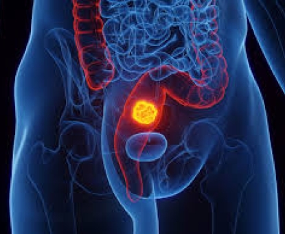 Tại sao mổ ung thư trực tràng phải vét hạch lympho